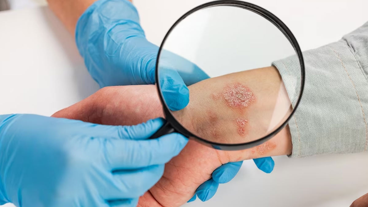 Men, Wealthy People More Prone To Skin Cancer: Study